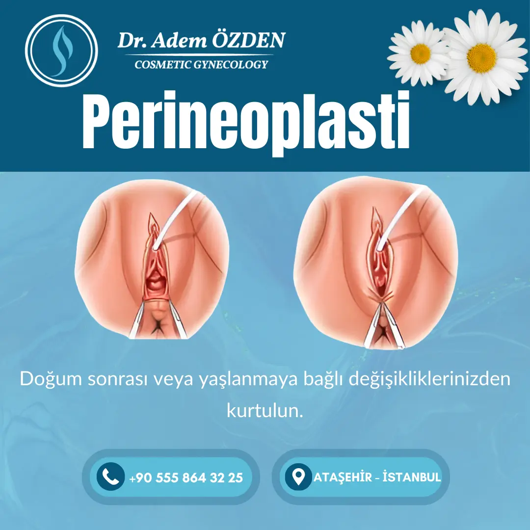 perienoplasti