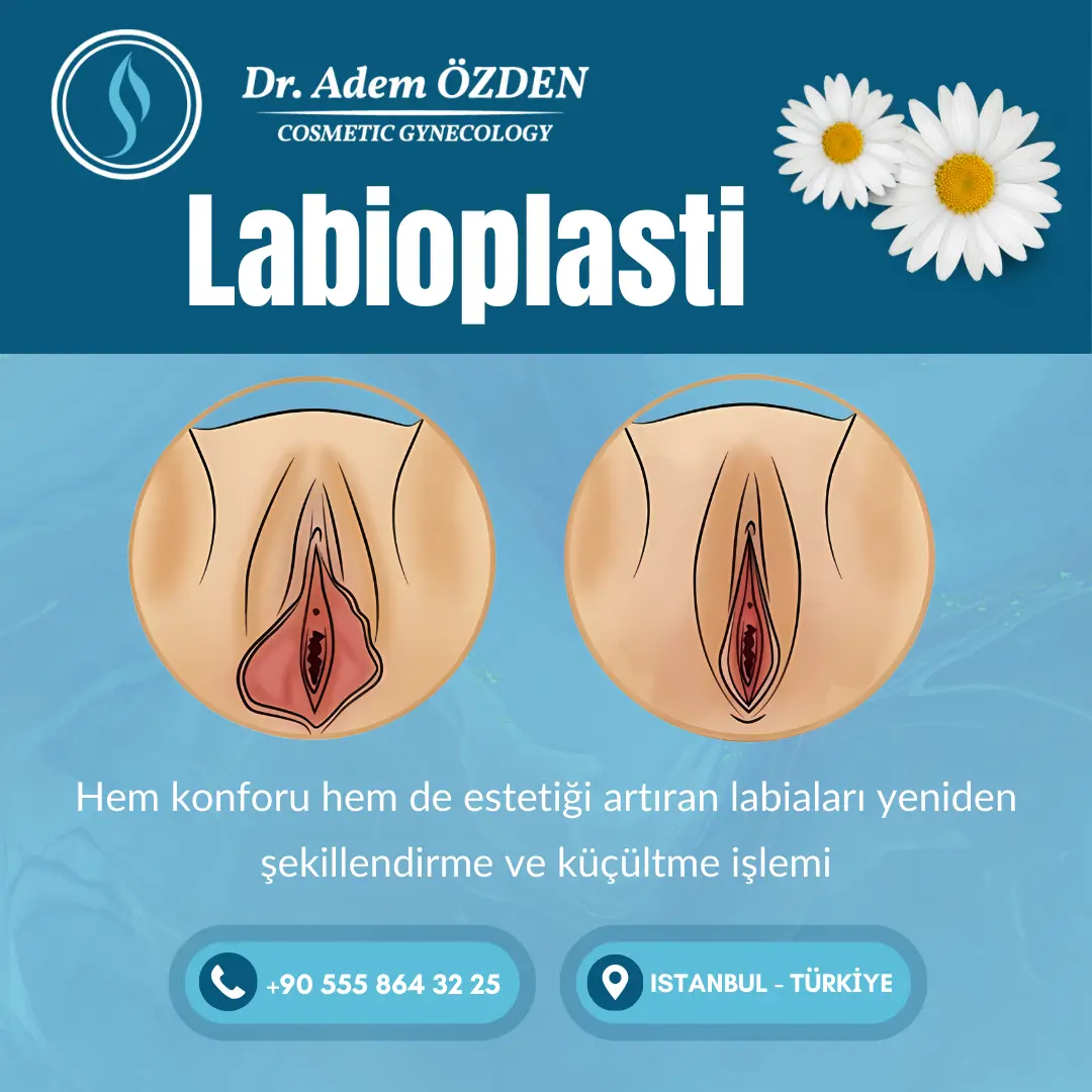 labioplasti