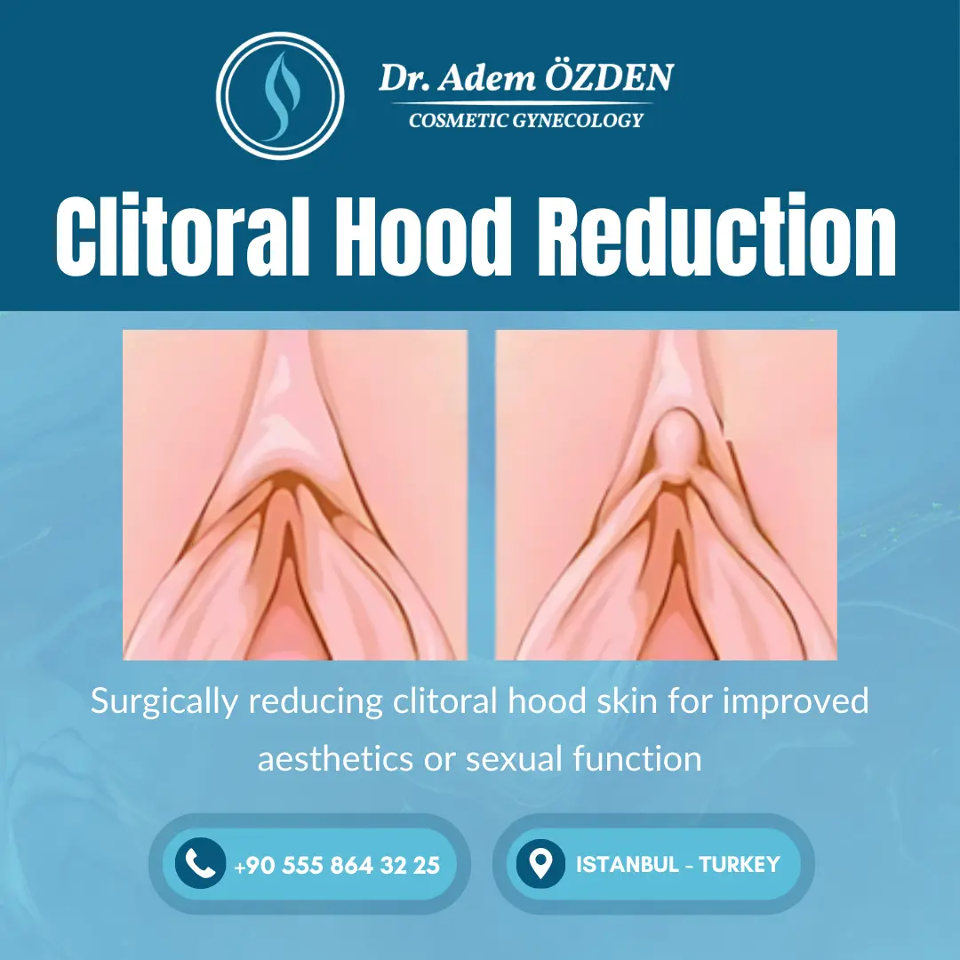 clitoral-hood-reduction